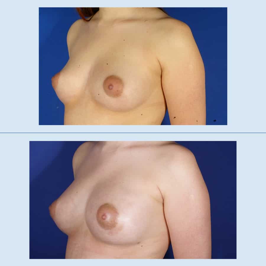 Breast augmentation with own fat