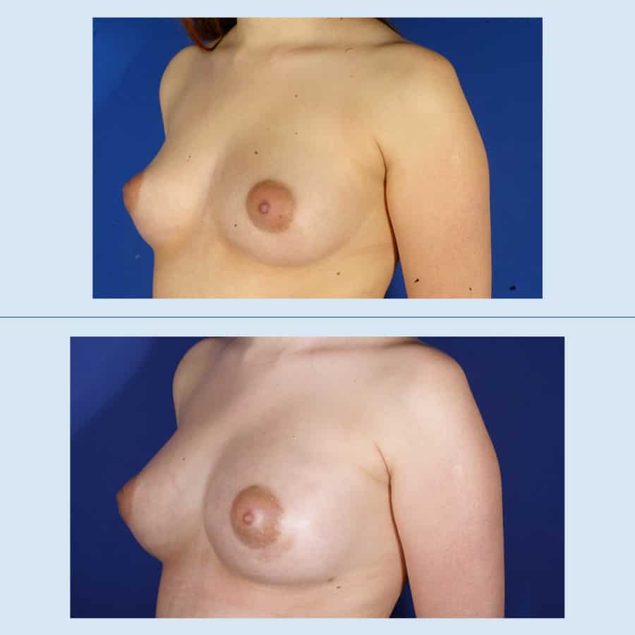 Antes y Después Breast augmentation with own fat