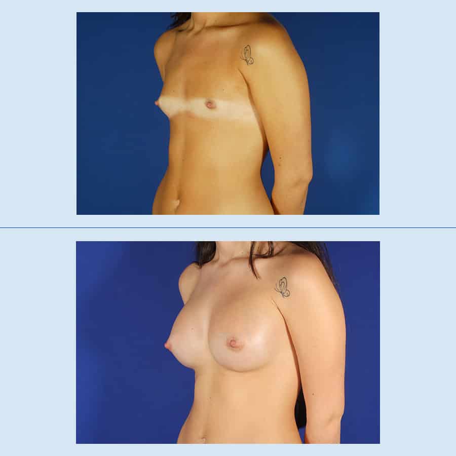 Antes y Después Augment de mames amb pròtesi