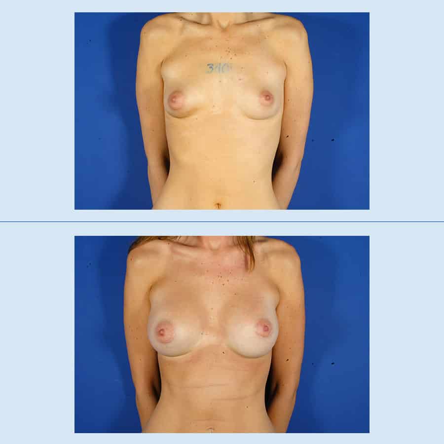 Antes y Después Augment de mames amb pròtesi