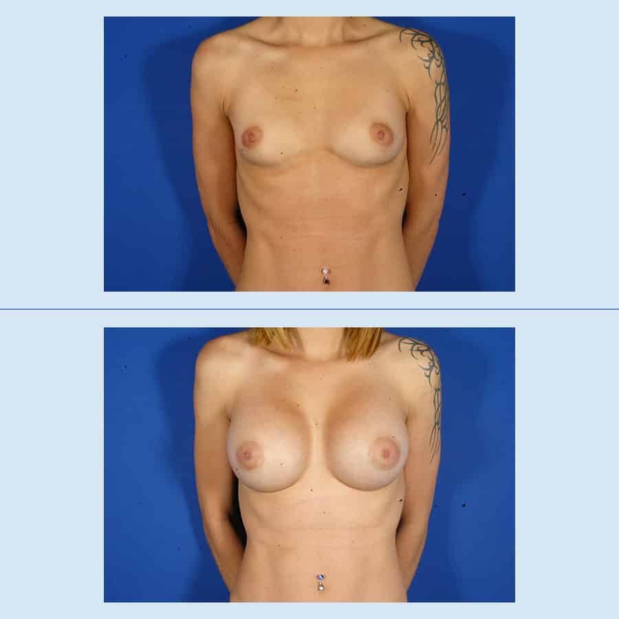 Antes y Después Augment de mames amb pròtesi