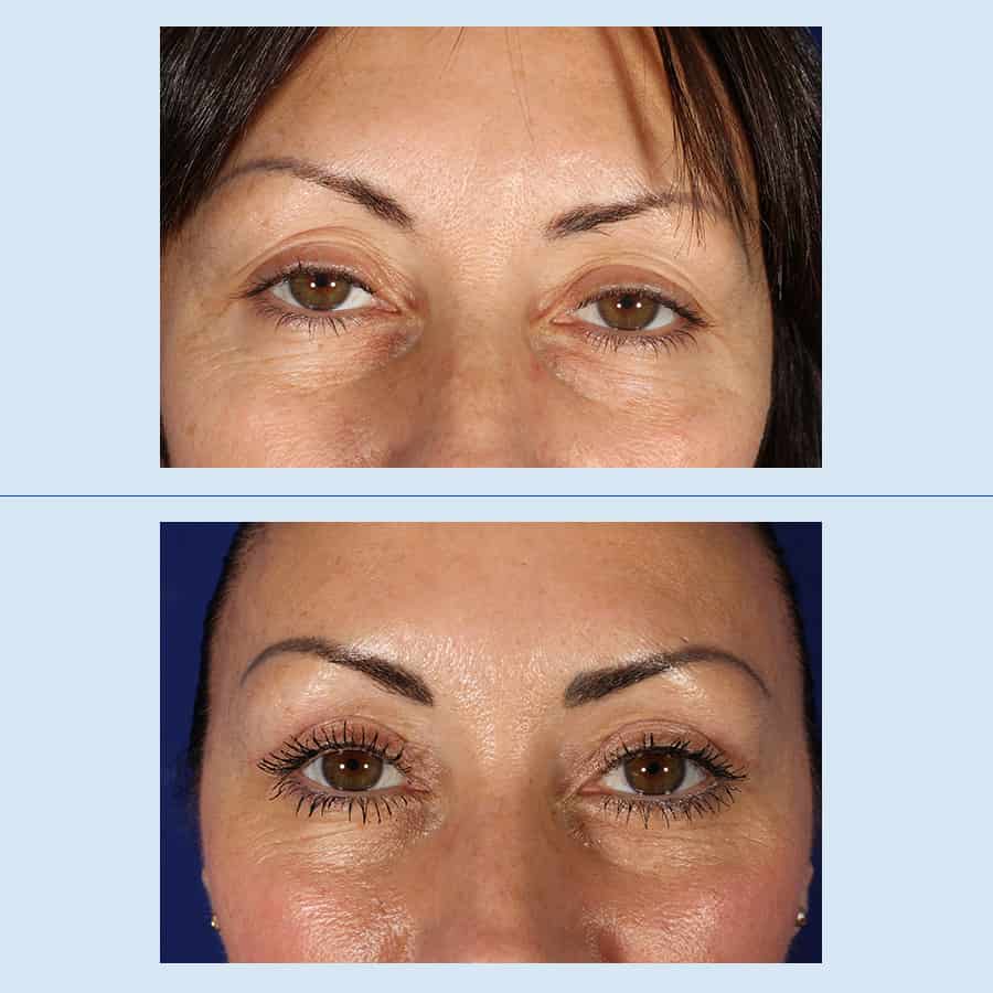 Antes y Después Blepharoplasty