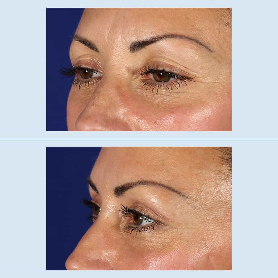 Antes y Después Blepharoplasty