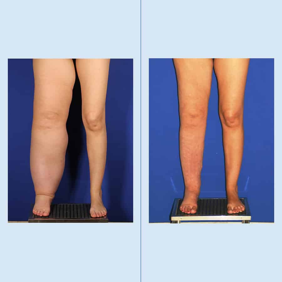 Antes y Después Lymphedema and Lipedema Surgery