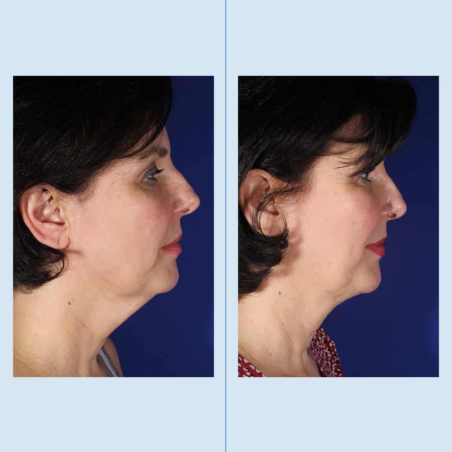 Antes y Después Chin Surgery
