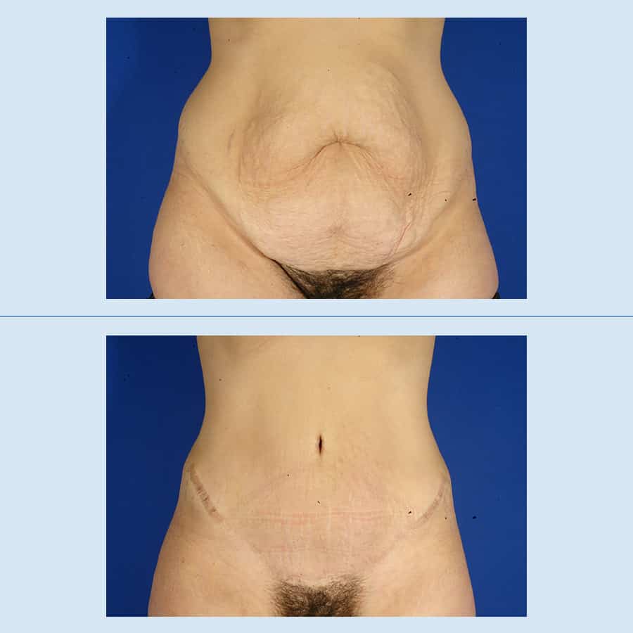 Antes y Después Cirurgia de l’abdomen