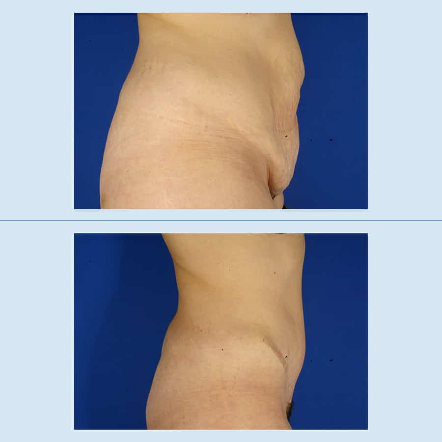 Abdominoplastia - Antes y Después - 9