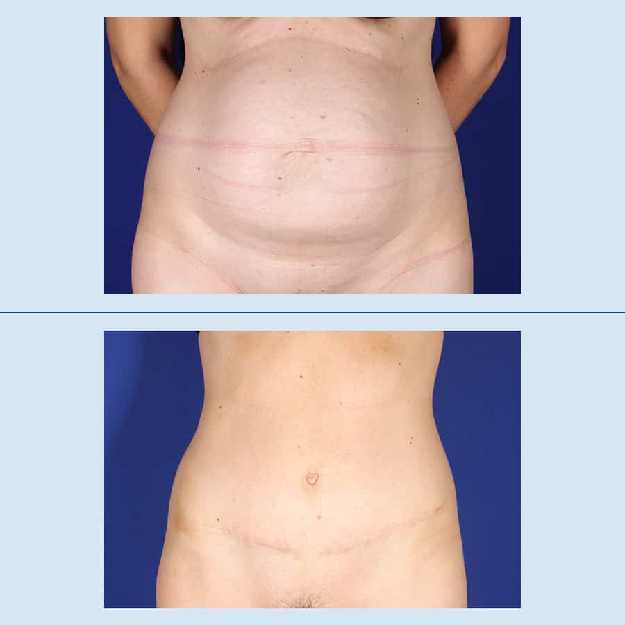 Antes y Después Cirurgia de l’abdomen