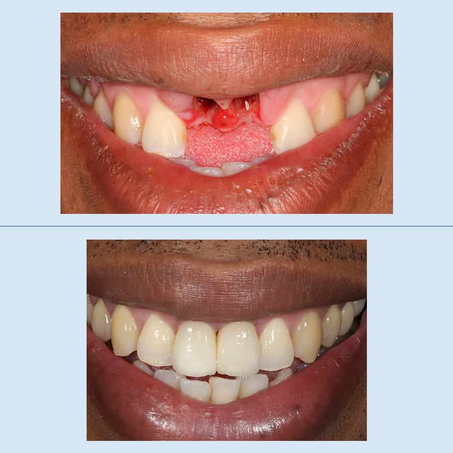 Antes y Después Periodontics and Dental Implants