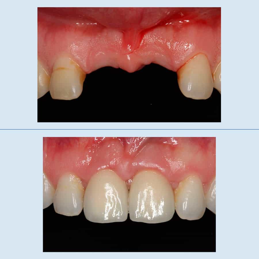 Antes y Después Implantes Dentales