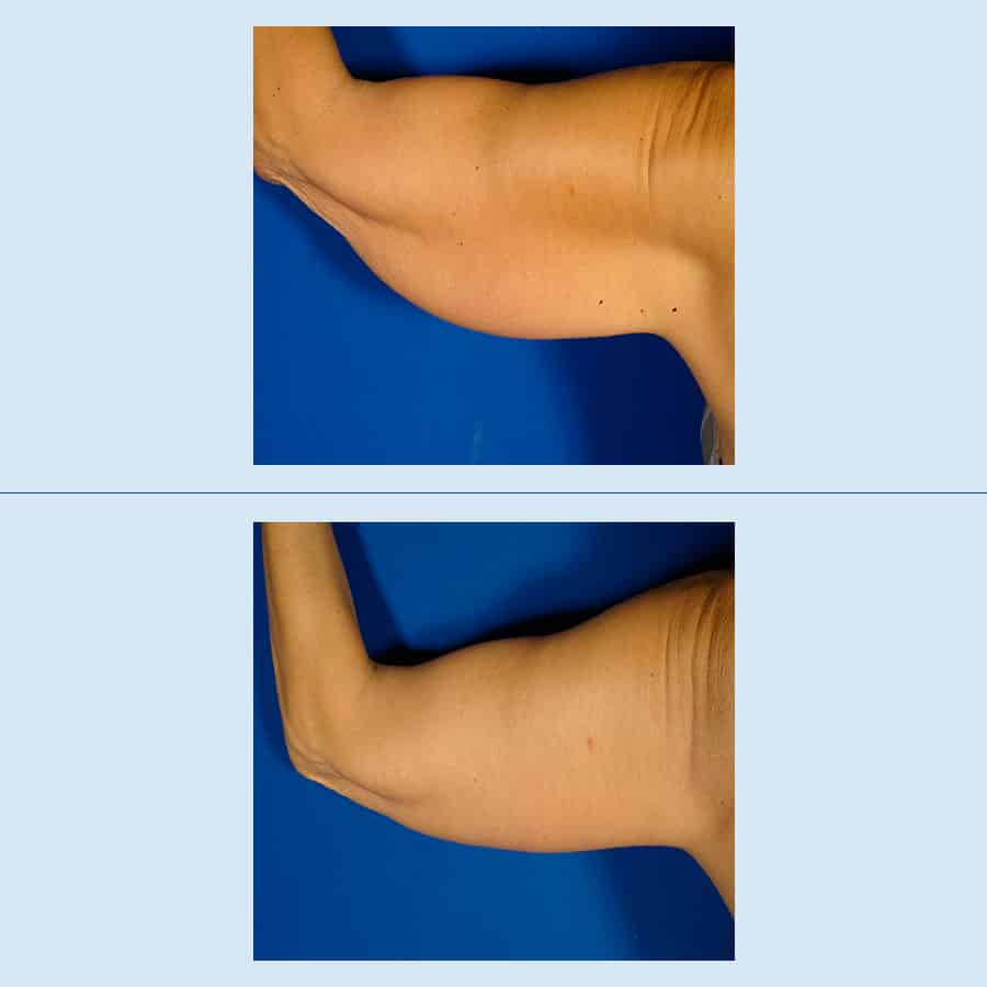 Antes y Después Braquioplastia | Lifting de Brazos