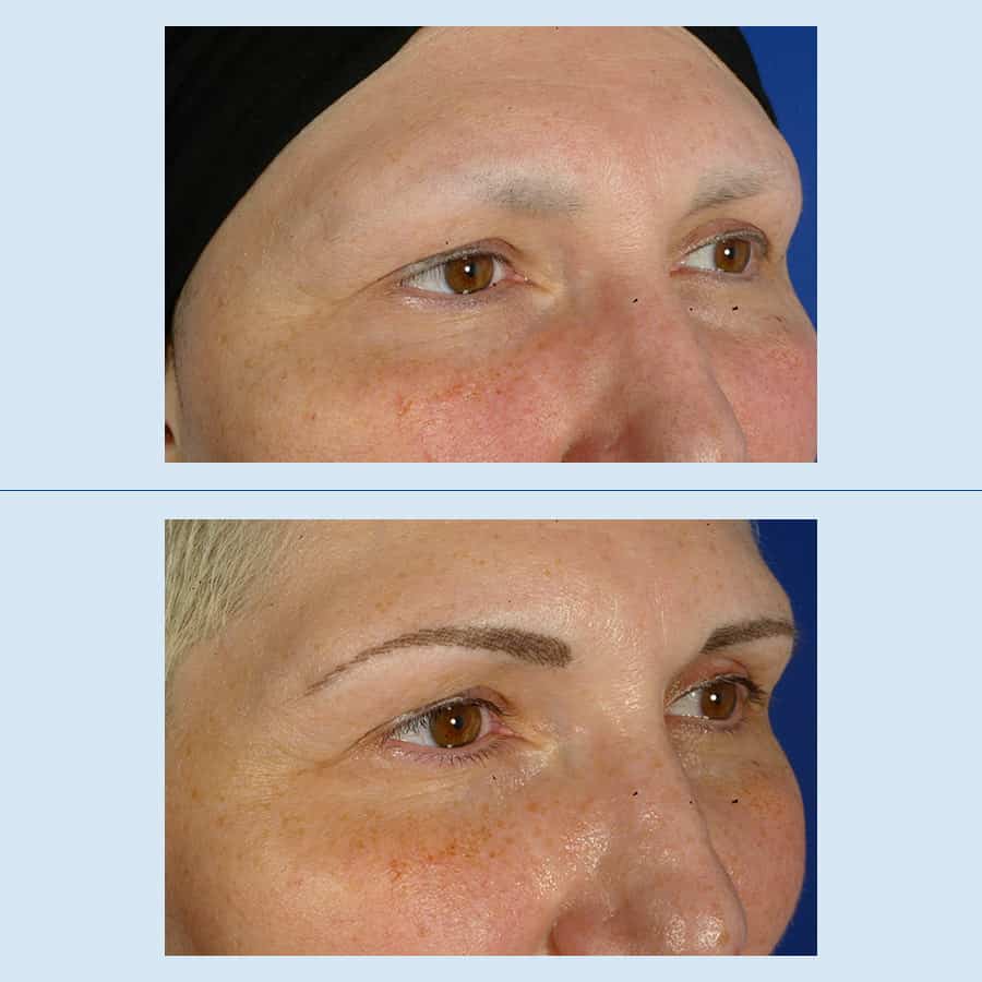 Antes y Después Micropigmentation