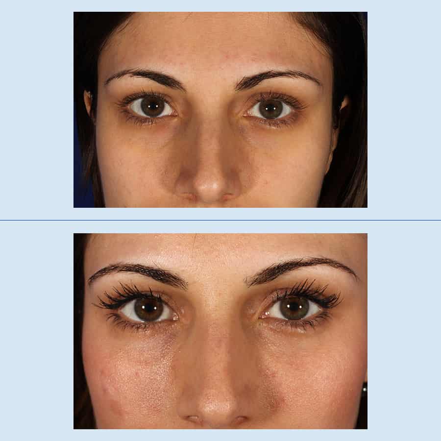 Antes y Después Removal of dark circles