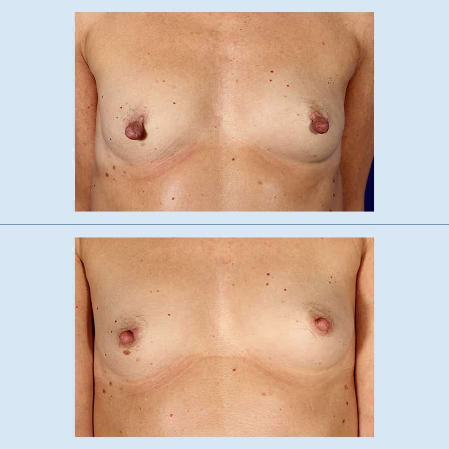 Antes y Después Areola / Nipple Reduction Surgery