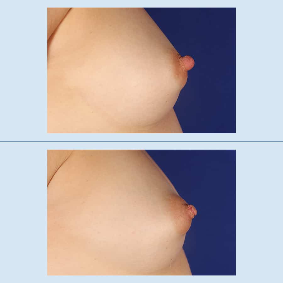 Antes y Después Reducción de Areolas /Pezón