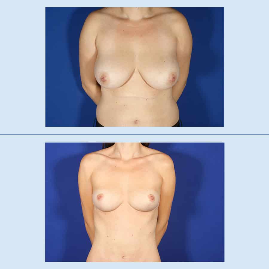 Antes y Después Breast Reduction