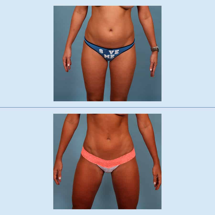 Antes y Después Lipo Vaser