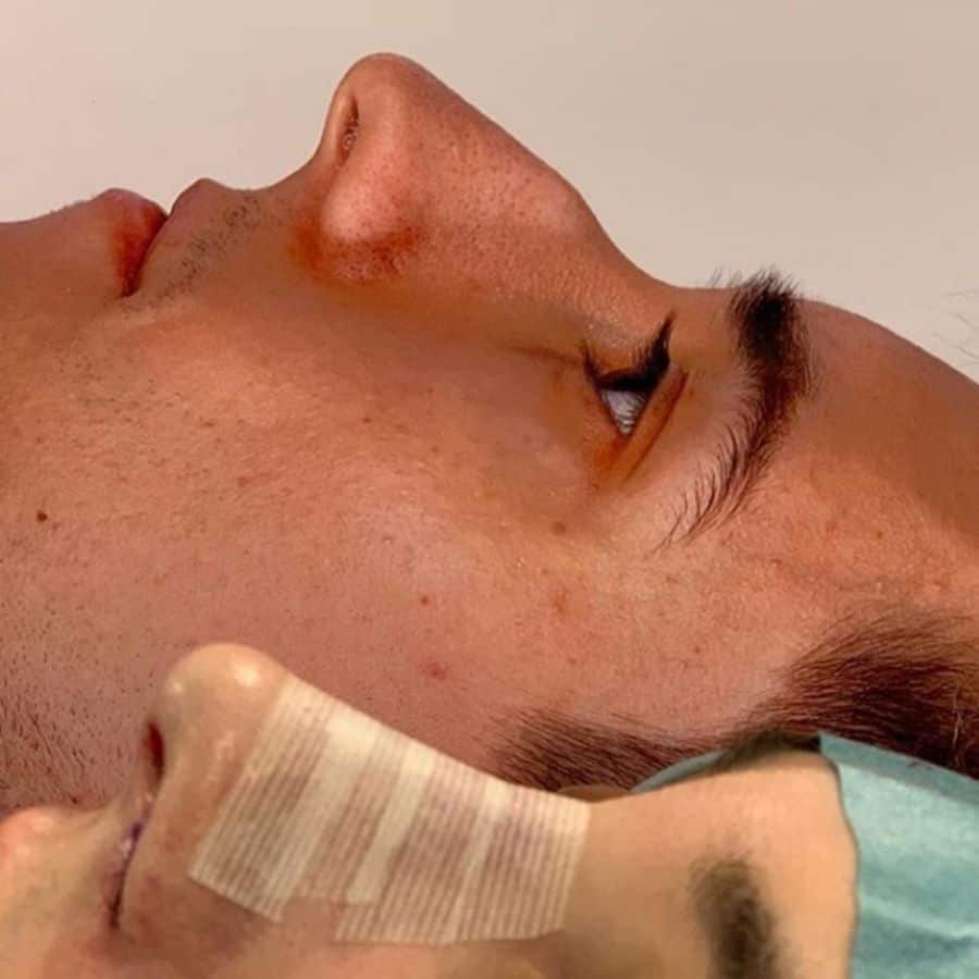 Ultrasonic Rhinoplasty