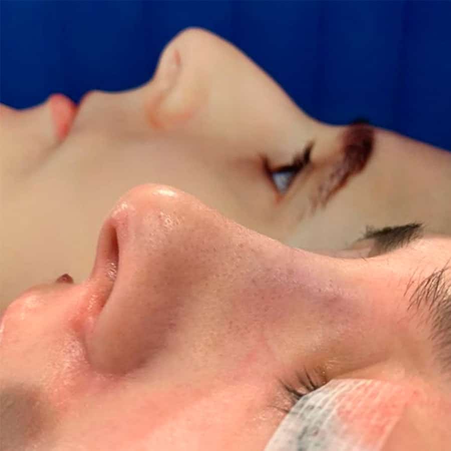 Ultrasonic Rhinoplasty