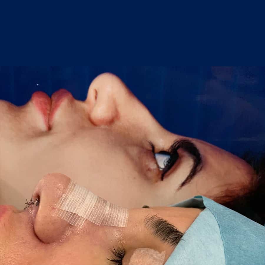 Ultrasonic Rhinoplasty