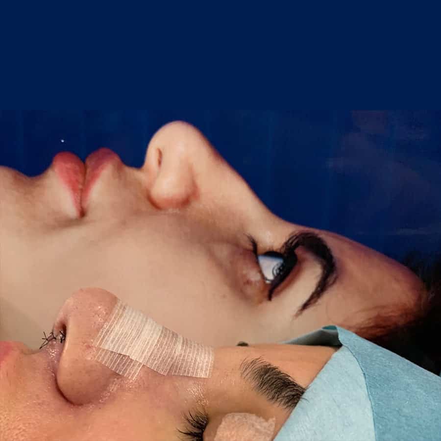Cirurgía del nas