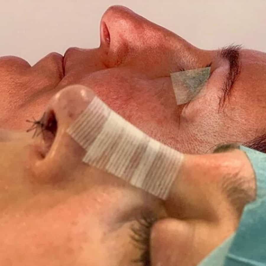 Ultrasonic Rhinoplasty