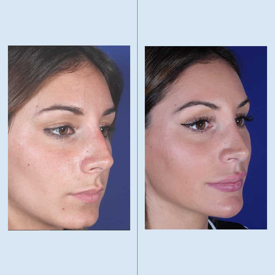 Rinoplastia Clinica Planas Barcelona Madrid