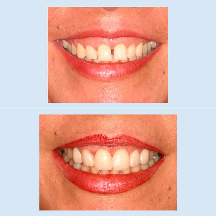 Antes y Después Somriure Gingival