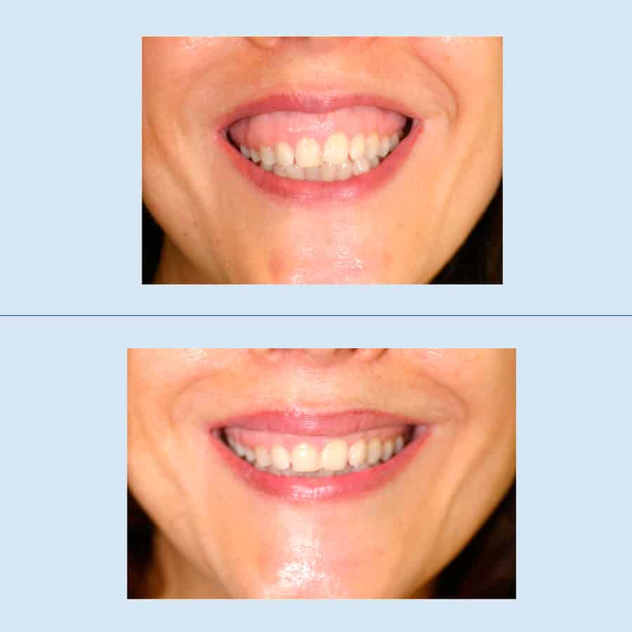 Antes y Después Sonrisa Gingival