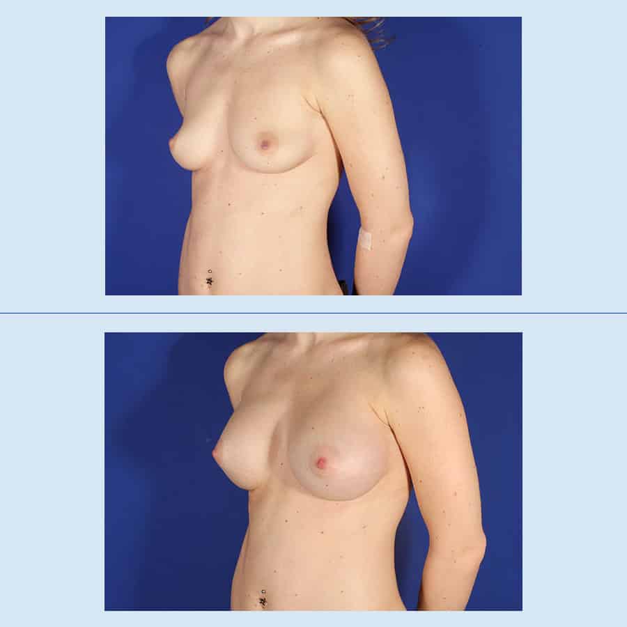 Antes y Después Breast augmentation with prosthesis