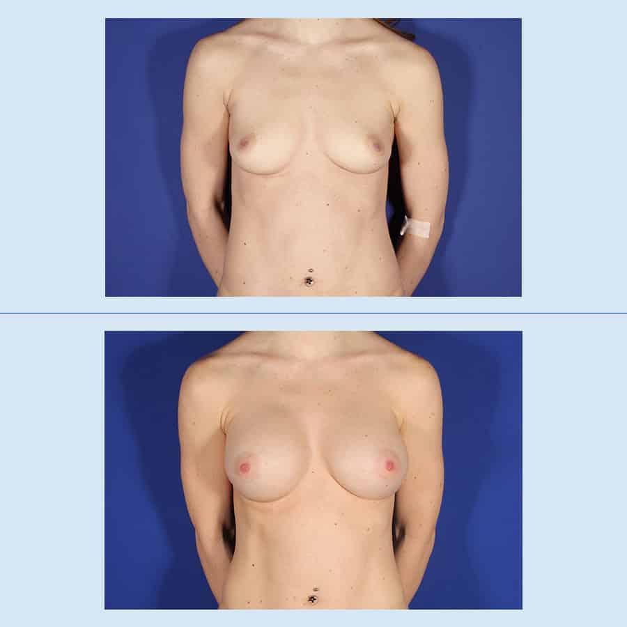 Breast augmentation with prosthesis