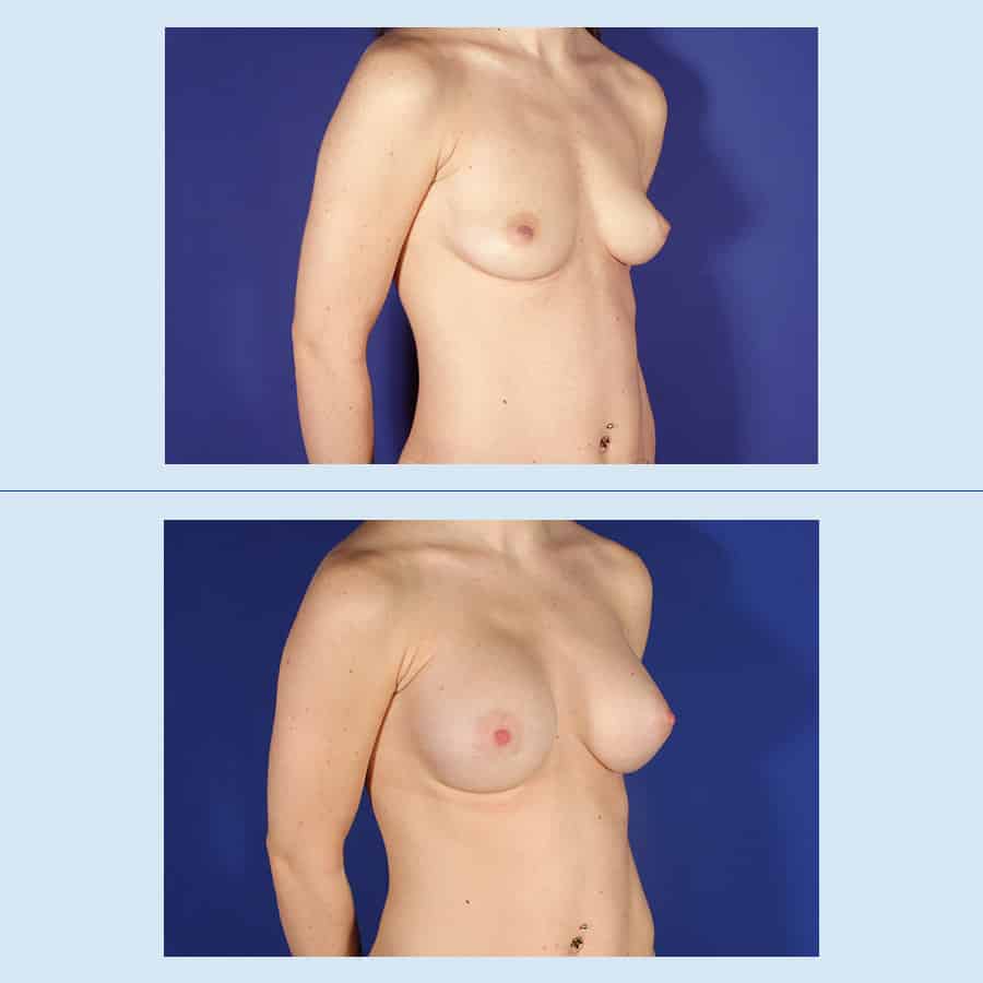 Antes y Después Augment de mames amb pròtesi