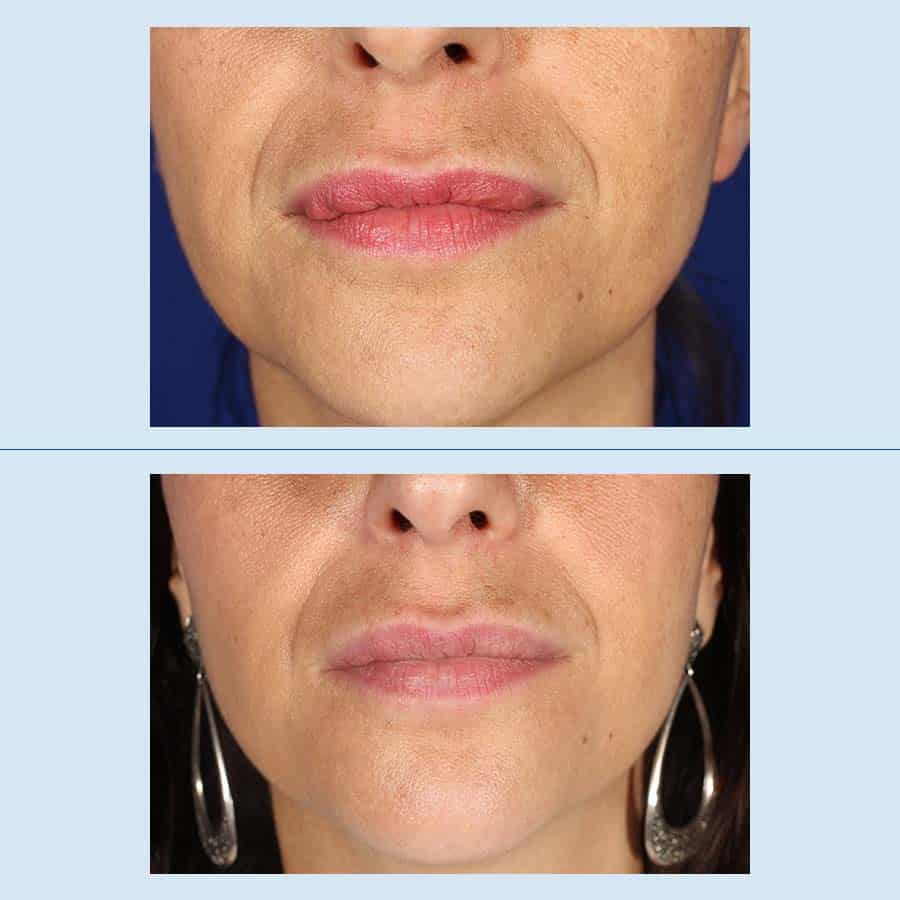 Antes y Después Removal of facial fillers