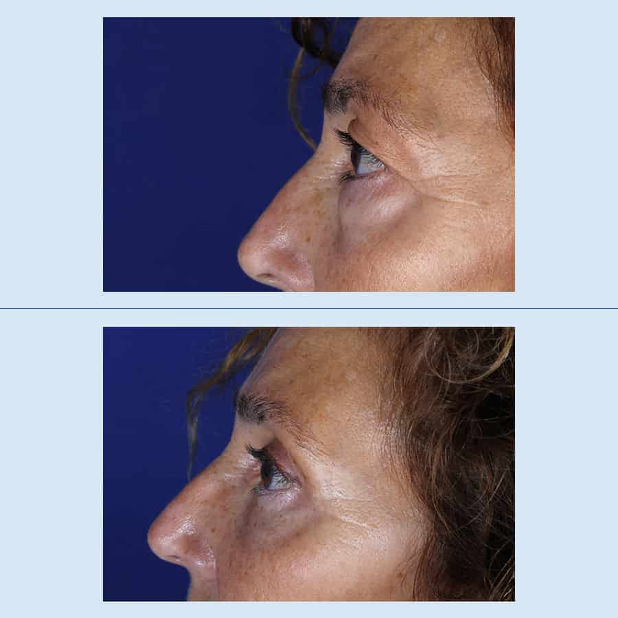 Antes y Después Blepharoplasty