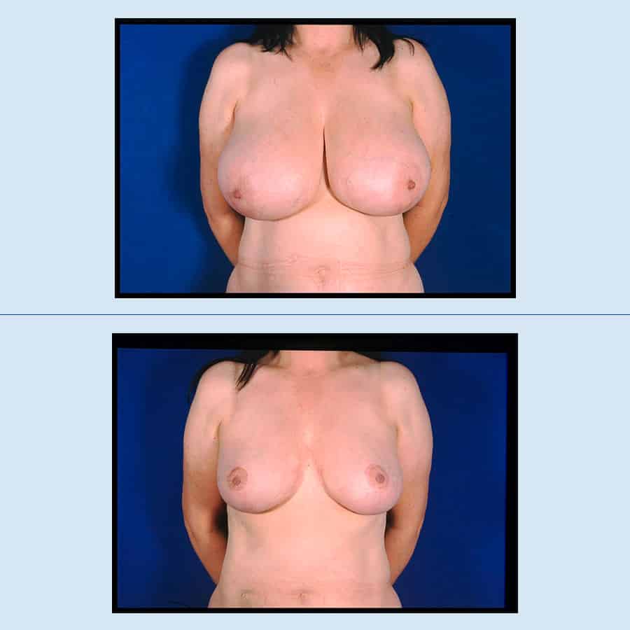 Antes y Después Breast Reduction