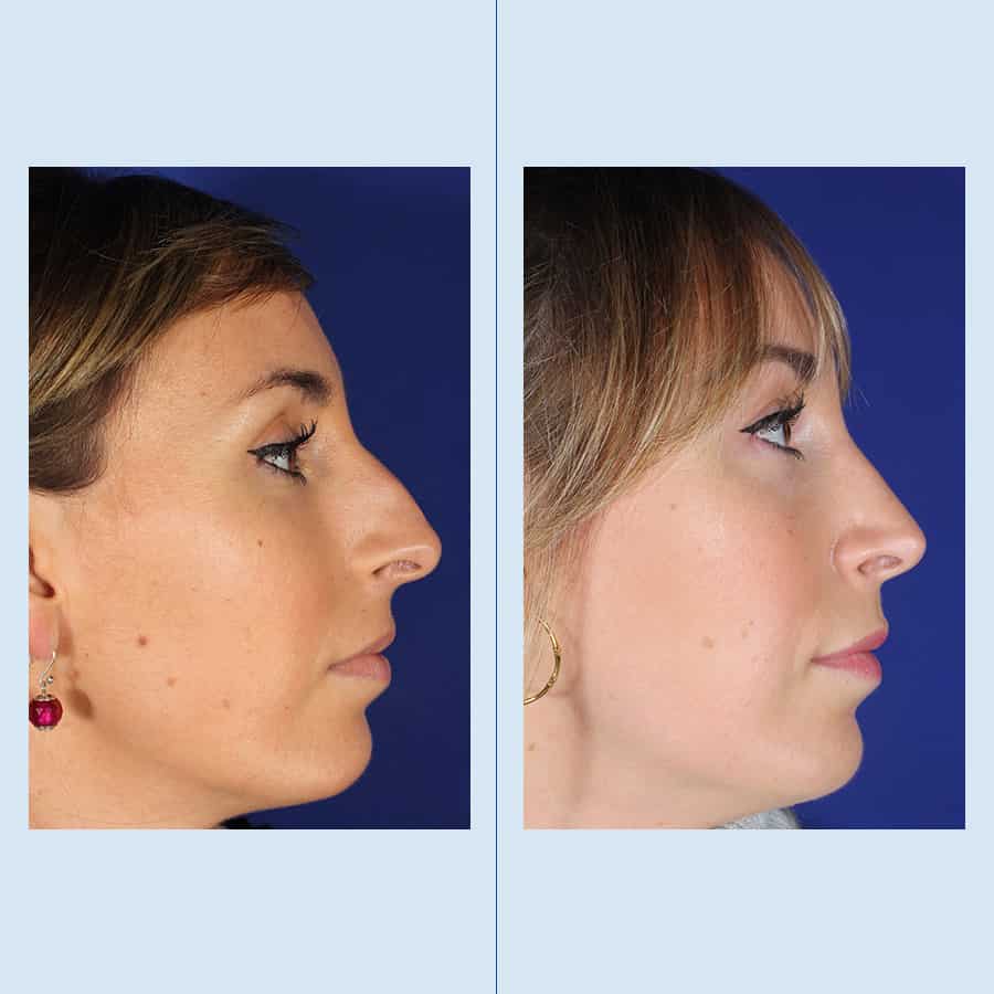 Rinoplastia Clinica Planas Barcelona Madrid