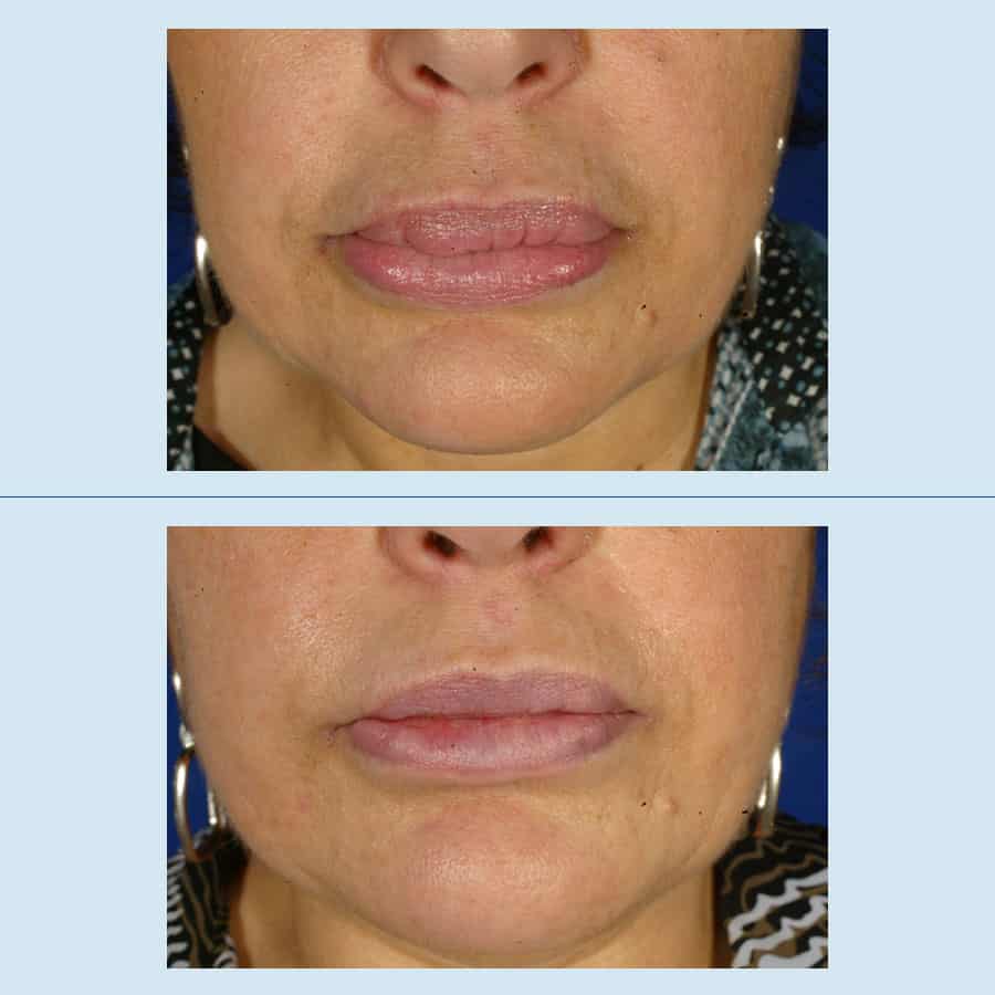 Antes y Después Removal of facial fillers