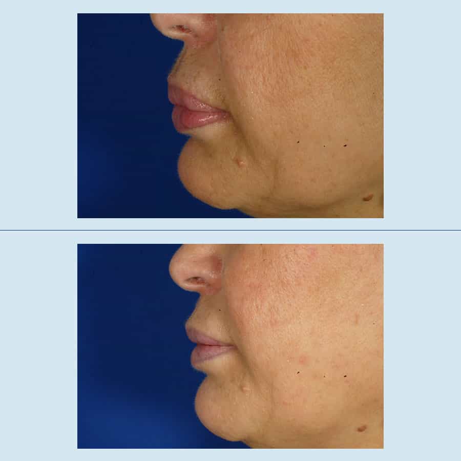 Antes y Después Removal of facial fillers