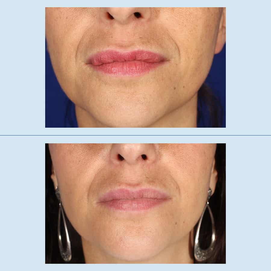 Antes y Después Removal of facial fillers
