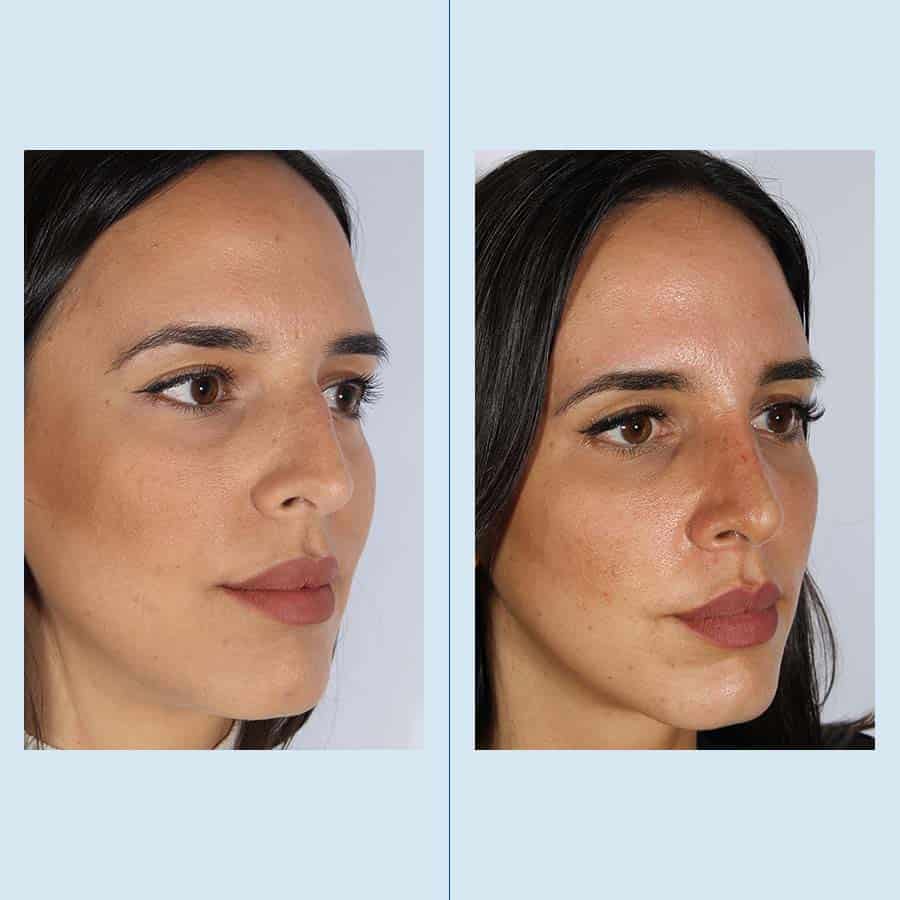 Rinoplastia Clinica Planas Barcelona Madrid