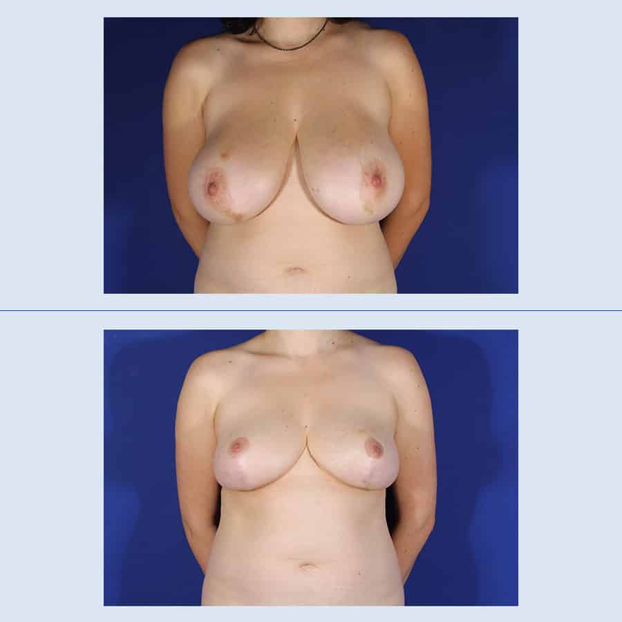 Antes y Después Breast Reduction