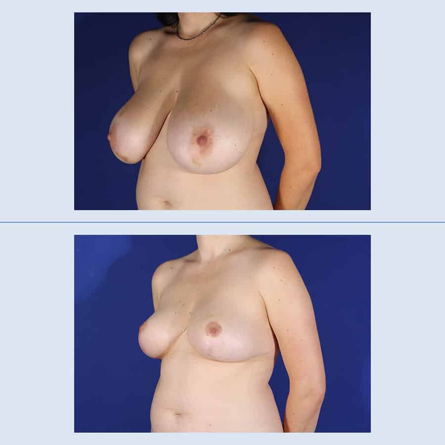 Antes y Después Breast Reduction