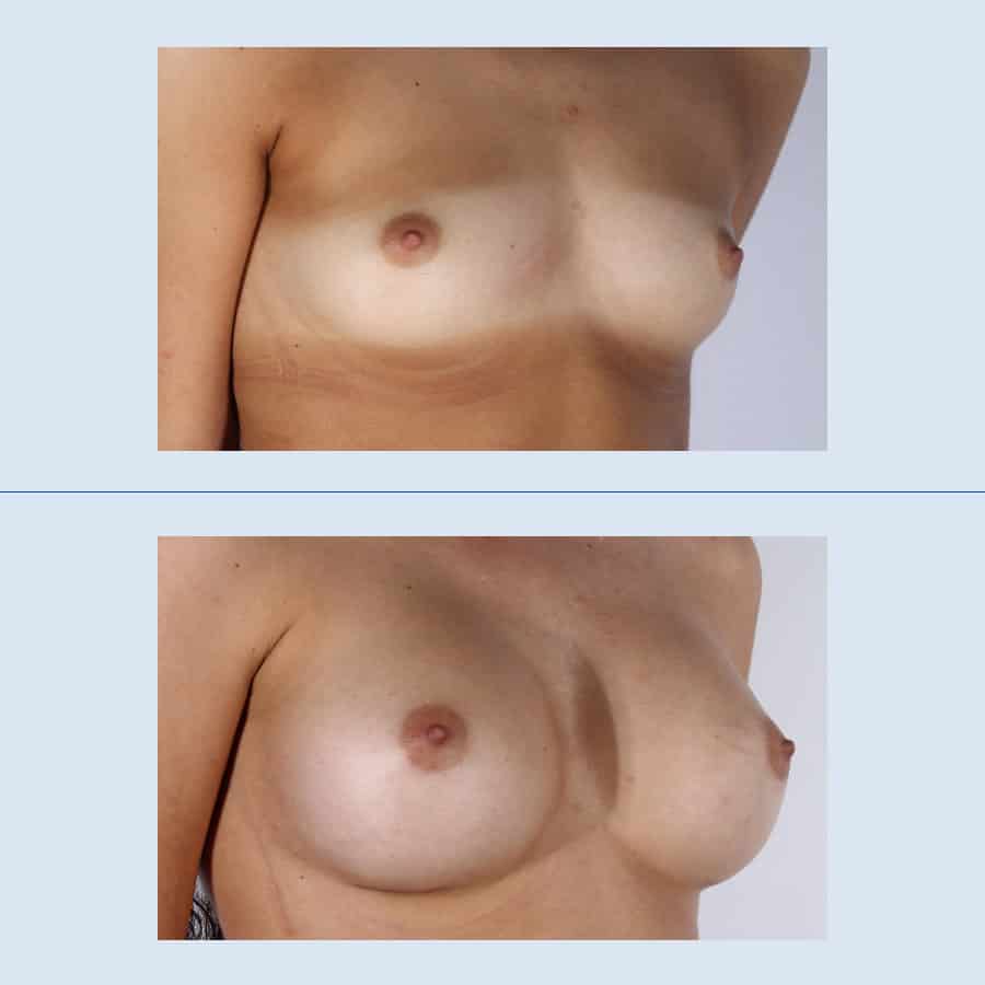 Breast augmentation with prosthesis