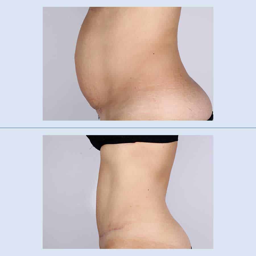 Antes y Después Cirurgia de l’abdomen