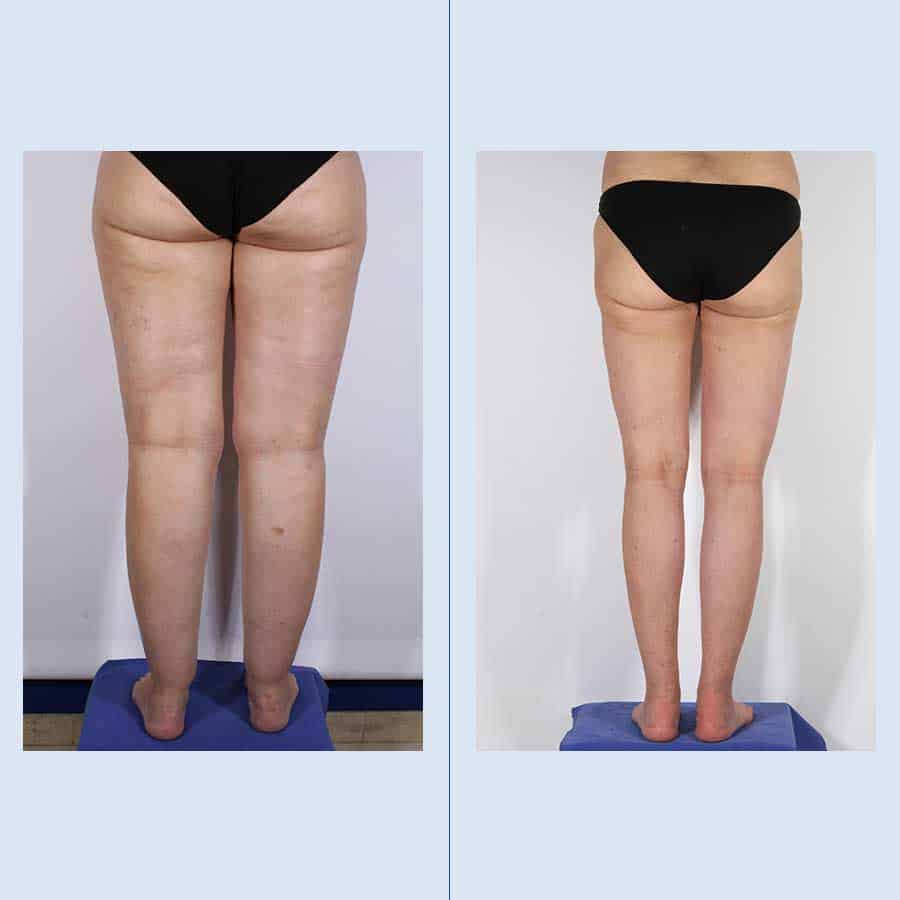 Antes y Después Cirugía de Lipedema