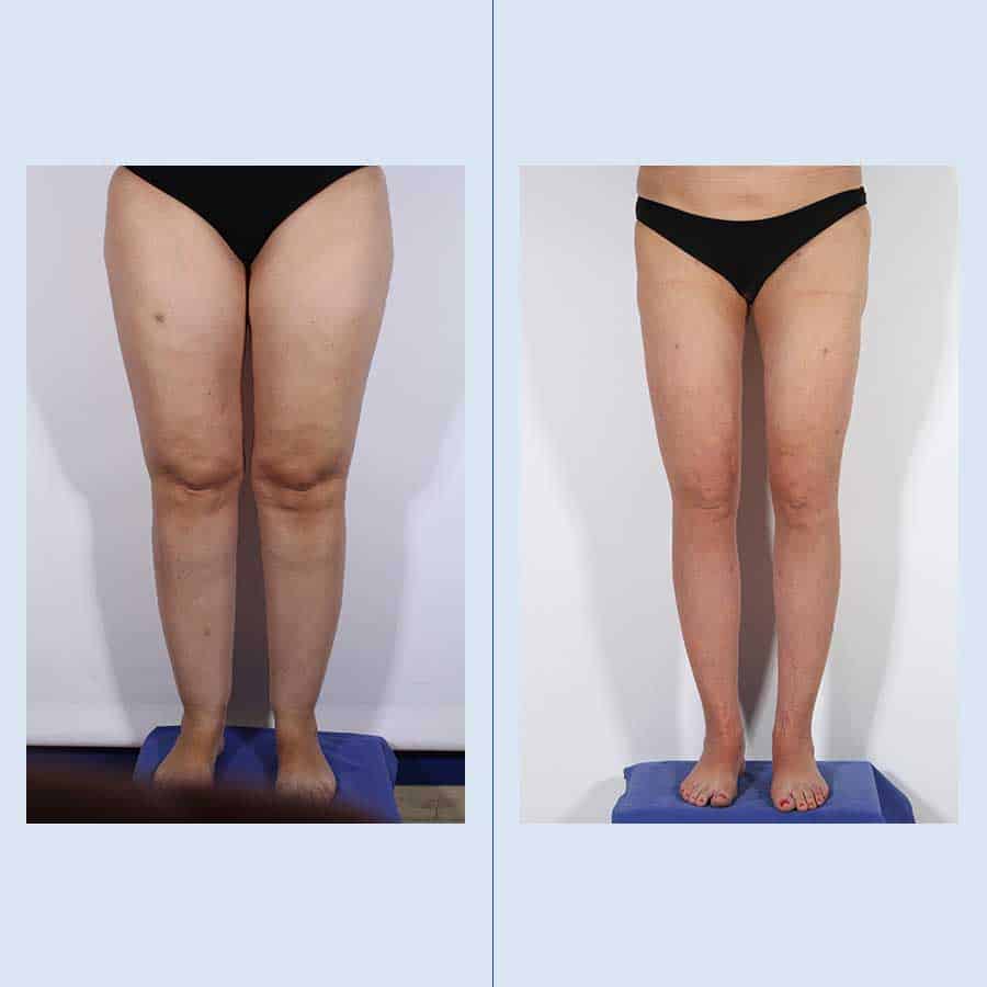 Antes y Después Cirugía de Lipedema