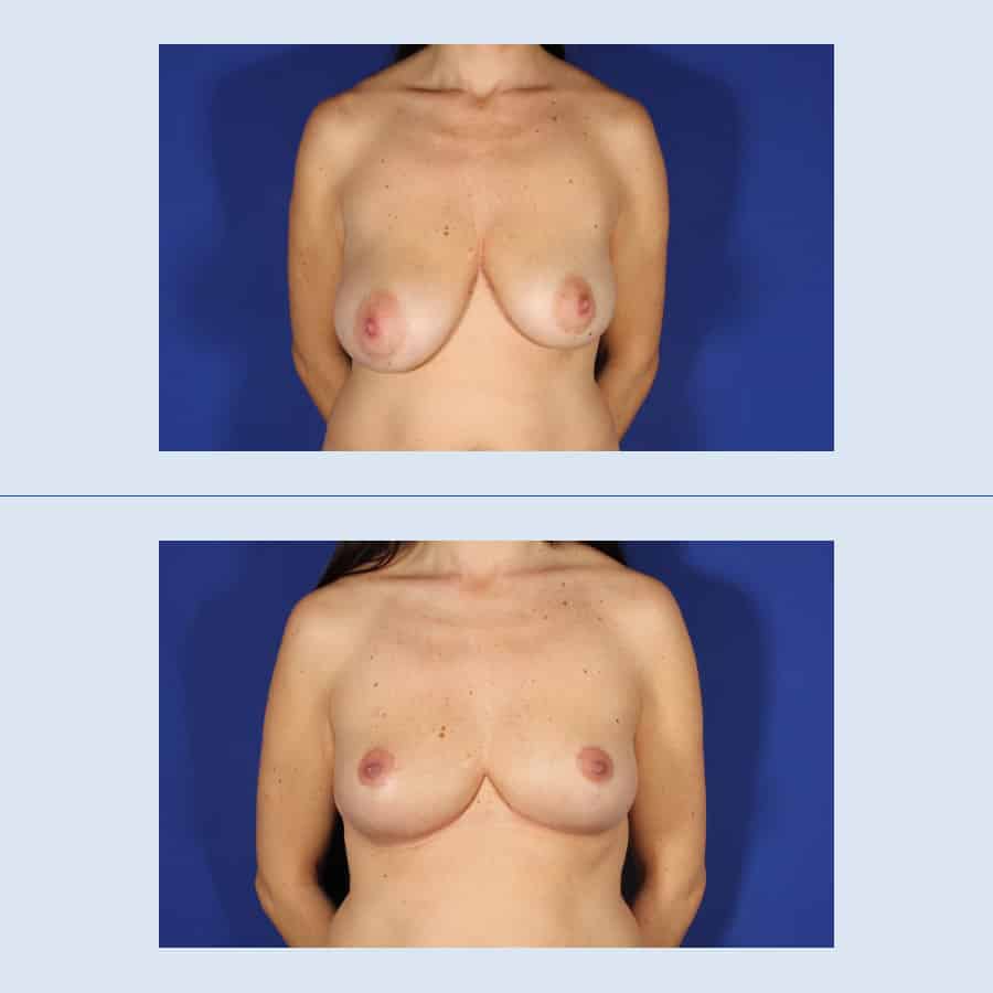 Antes y Después Breast Uplift