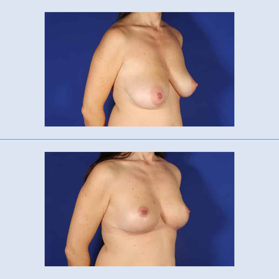 Antes y Después Breast Uplift