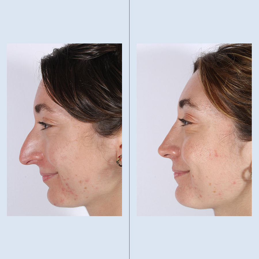 Antes y Después Ultrasonic Rhinoplasty