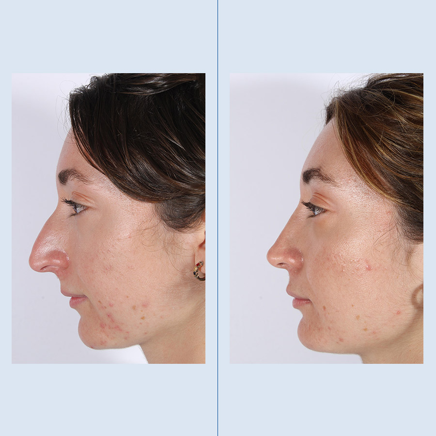 Rinoplastia Ultrasónica